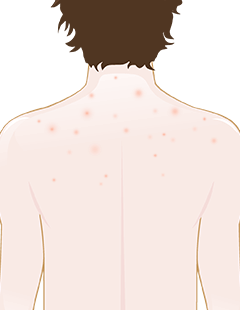 Keratosis Pilaris