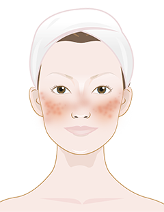 rosacea