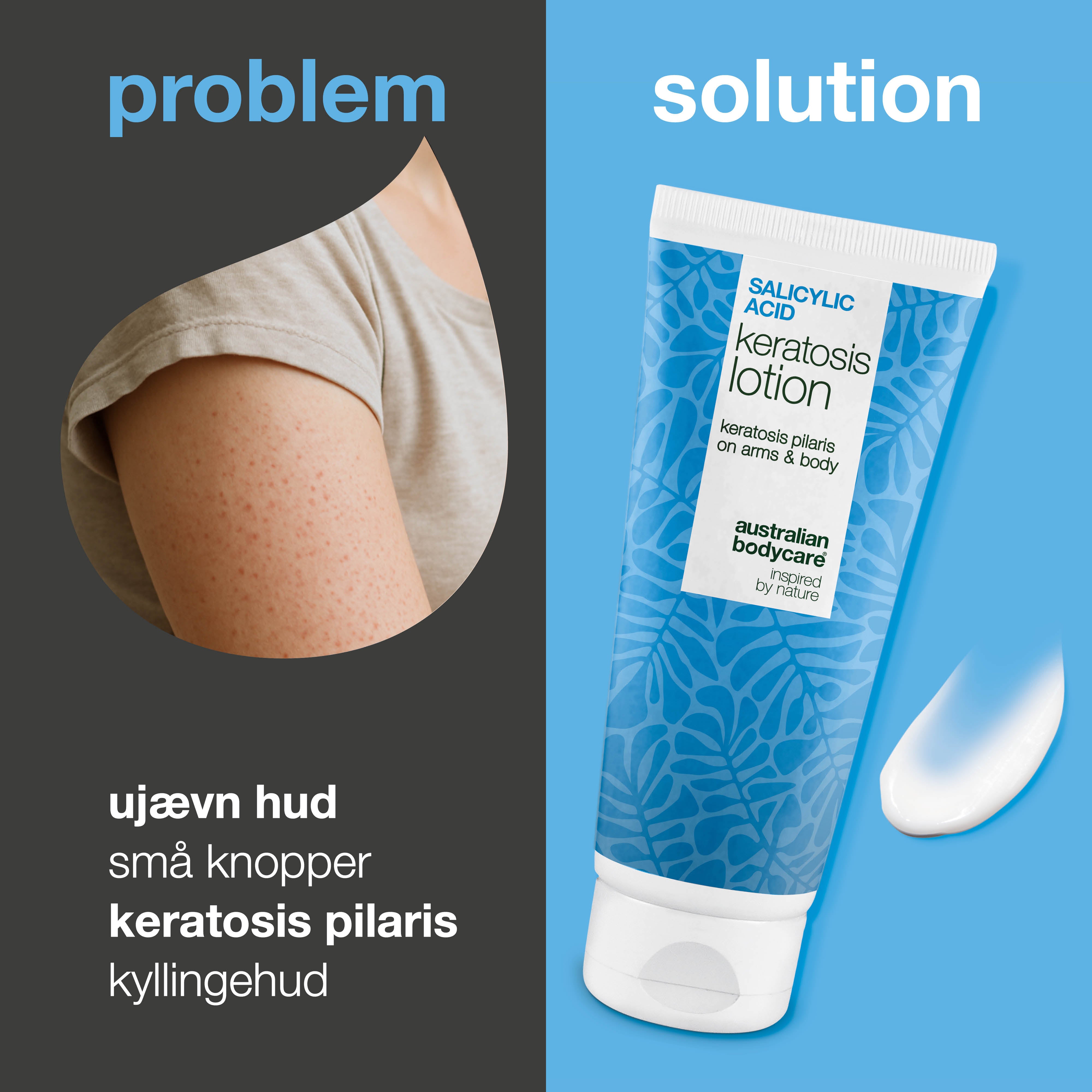 Body lotion mod keratosis pilaris og ru hud med små knopper — Body lotion mod keratosis pilaris og tør hud. Udglatter med salicylsyre, niacinamid og zink.