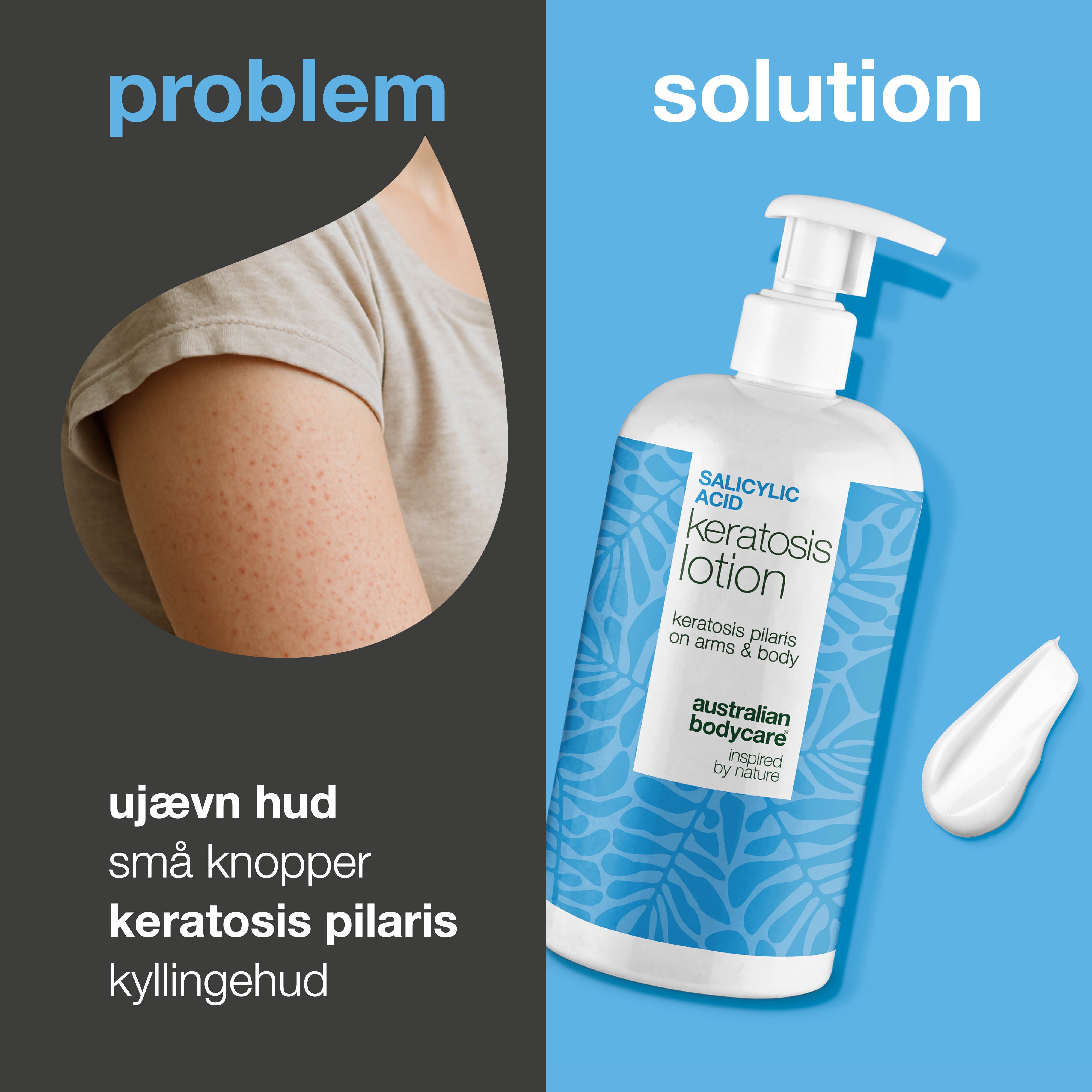 Body lotion mod keratosis pilaris og ru hud med små knopper — Body lotion mod keratosis pilaris og tør hud. Udglatter med salicylsyre, niacinamid og zink.