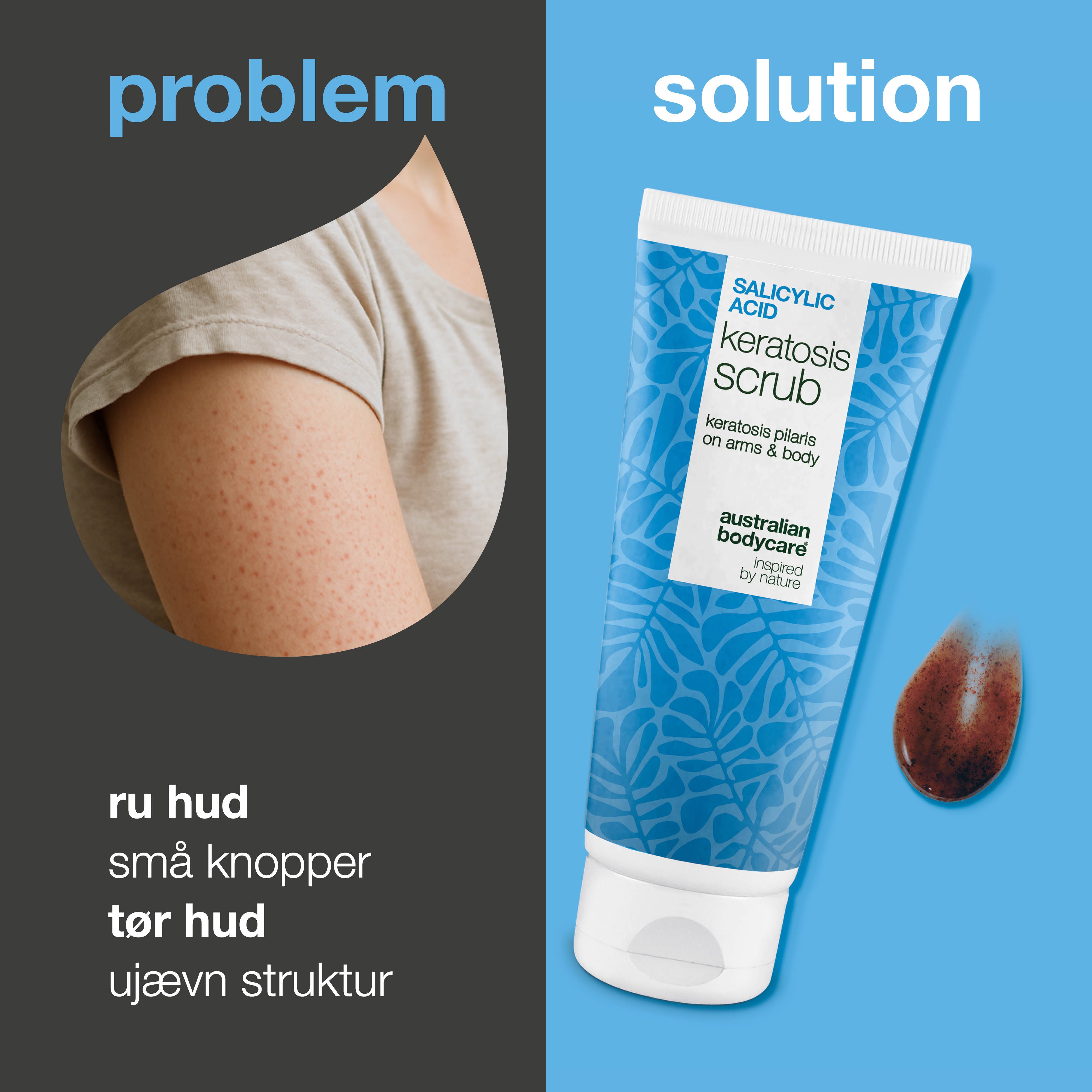 Keratosis Pilaris Body Scrub fjerner døde hudceller og reducerer knopper. Gør huden blødere og jævn med salicylsyre, allantoin og glykolsyre.