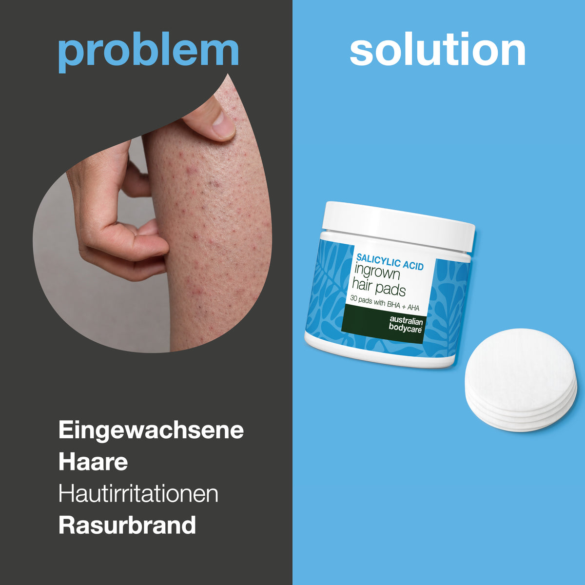 Problem og løsning: indgroede hår, barberknopper, hudirritation og jordbærben. Til venstre et nærbillede af et ben med røde knopper, til højre Salicylsyre pads mod indgroede hår fra Australian Bodycare med tre pads ved siden af