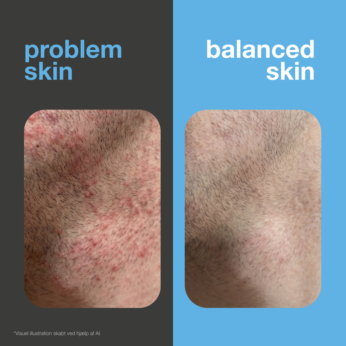 Før og efter: barberet hud med røde barberknopper og irritation over for glat og rolig hud. Visuel illustration.