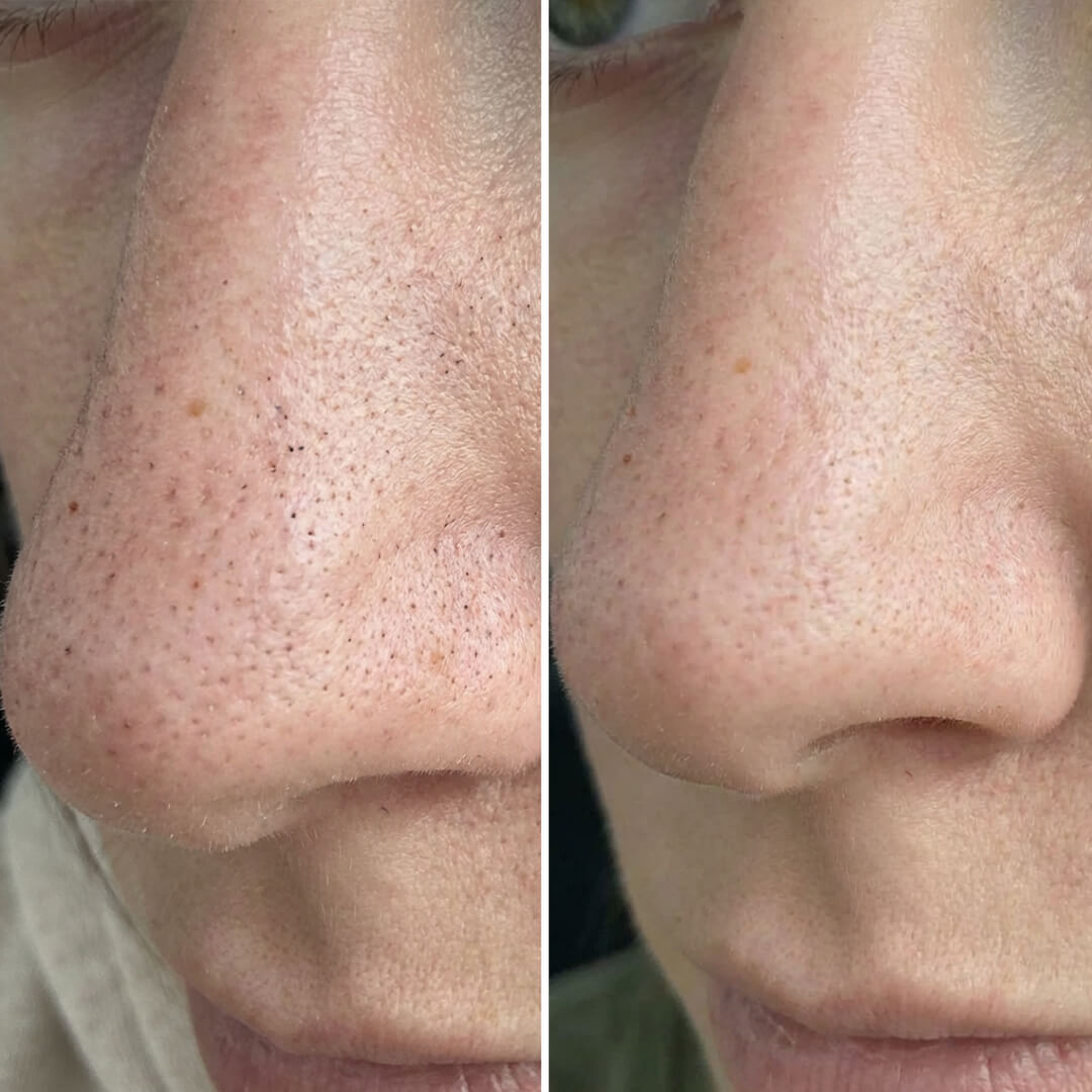 Pakke mod hudorme og tilstoppede porer med salicylsyre – dybderensende rutine for glat og klar hud