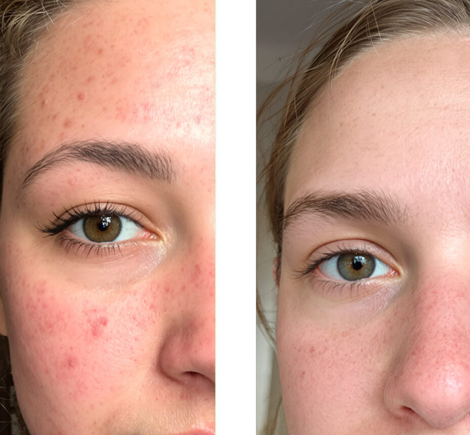 Før/efter billede af kunde ved brug af vores 2% Salicylic Acid Face Toner/Peeling/Exfoliant, som viser stor forbedring i huden med færre bumser og urenheder.