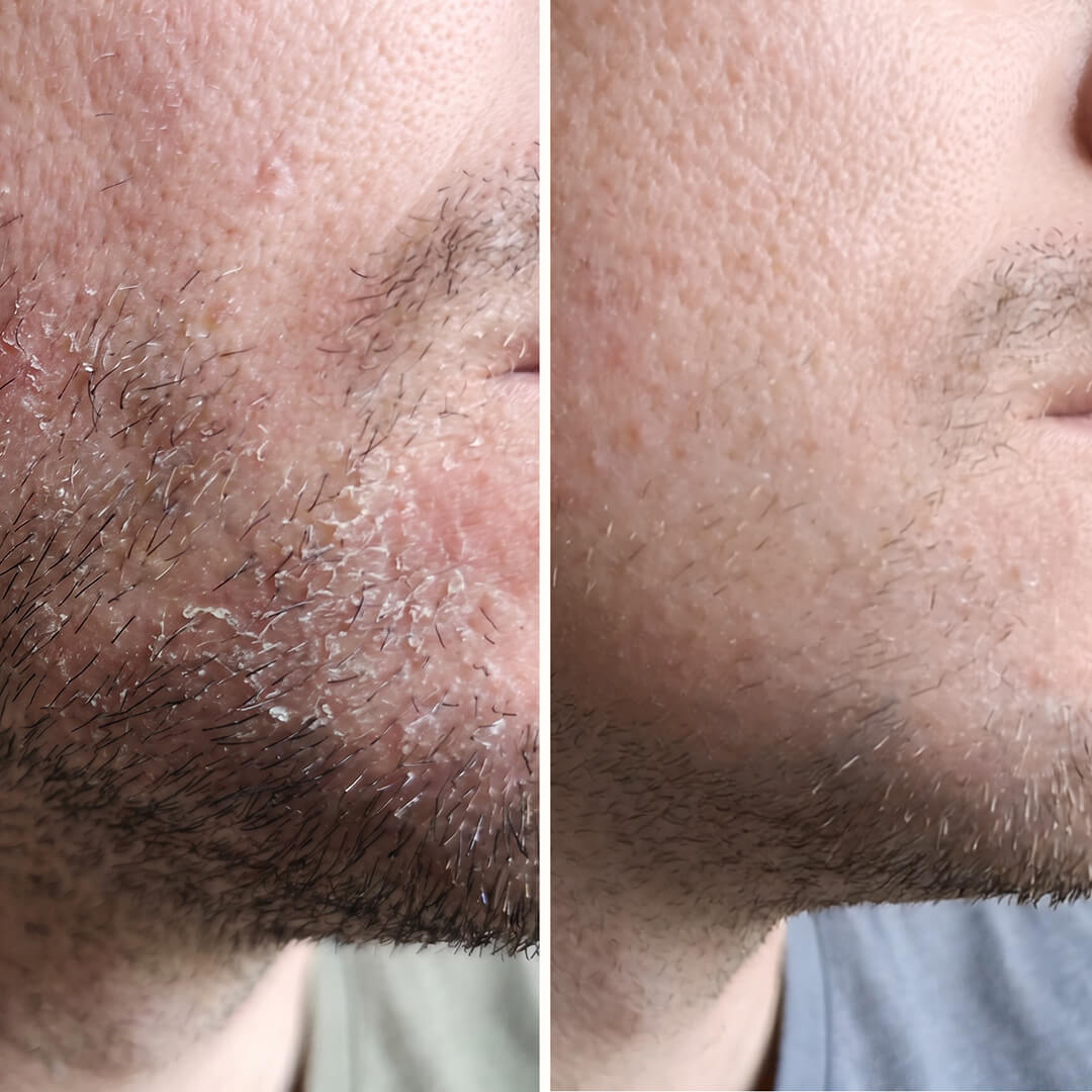 Salicylsyre serum til skæl og flager i ansigt og skæg — Serum til skæl i ansigtet, skæg, øre og øjenbryn. Salicylsyre fjerner flager og rødme hurtigt, så huden igen kommer i sund balance.