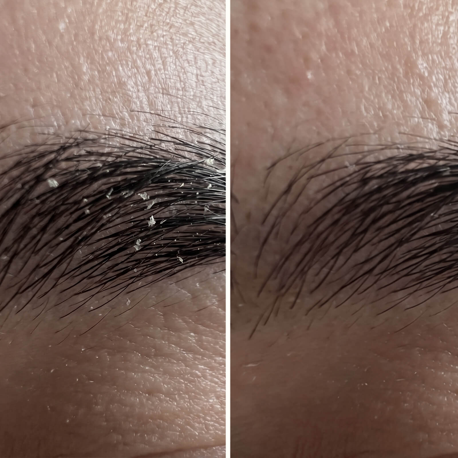 Salicylsyre serum til skæl og flager i ansigt og skæg — Serum til skæl i ansigtet, skæg, øre og øjenbryn. Salicylsyre fjerner flager og rødme hurtigt, så huden igen kommer i sund balance.