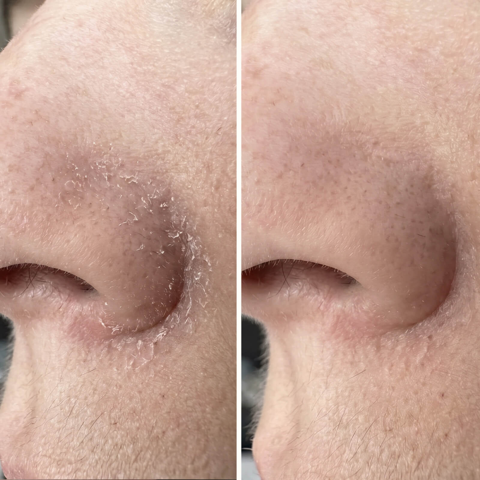 Salicylsyre serum til skæl og flager i ansigt og skæg — Serum til skæl i ansigtet, skæg, øre og øjenbryn. Salicylsyre fjerner flager og rødme hurtigt, så huden igen kommer i sund balance.
