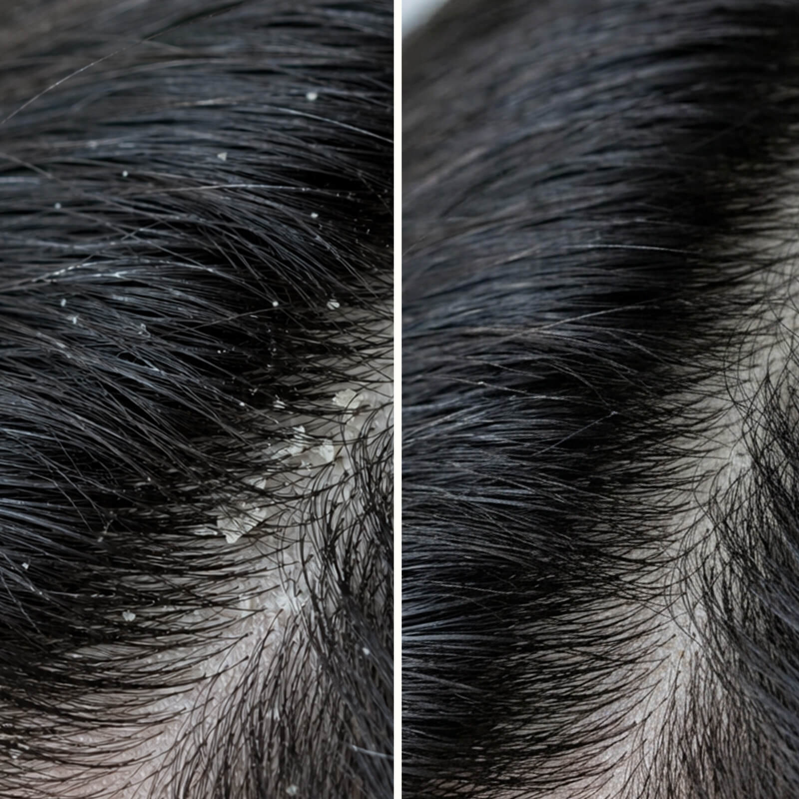 Salicylsyre Shampoo mod skæl, kløe og tør hovedbund — Shampoo mod skæl, kløe og tør hovedbund. Lindrer rødme og fjerner flager samt døde hudceller effektivt med eksfolierende salicylsyre.