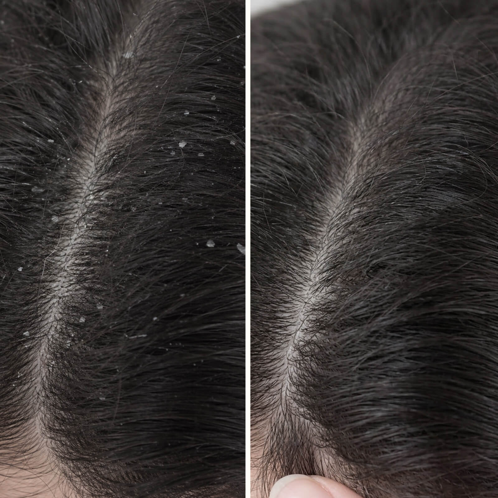 Balsam med Salicylsyre mod skæl og kløende hovedbund — Fugtgivende conditioner til tør hovedbund/hår og knækket hår. Giver blødt hår og lindring med effektiv Salicylsyre.