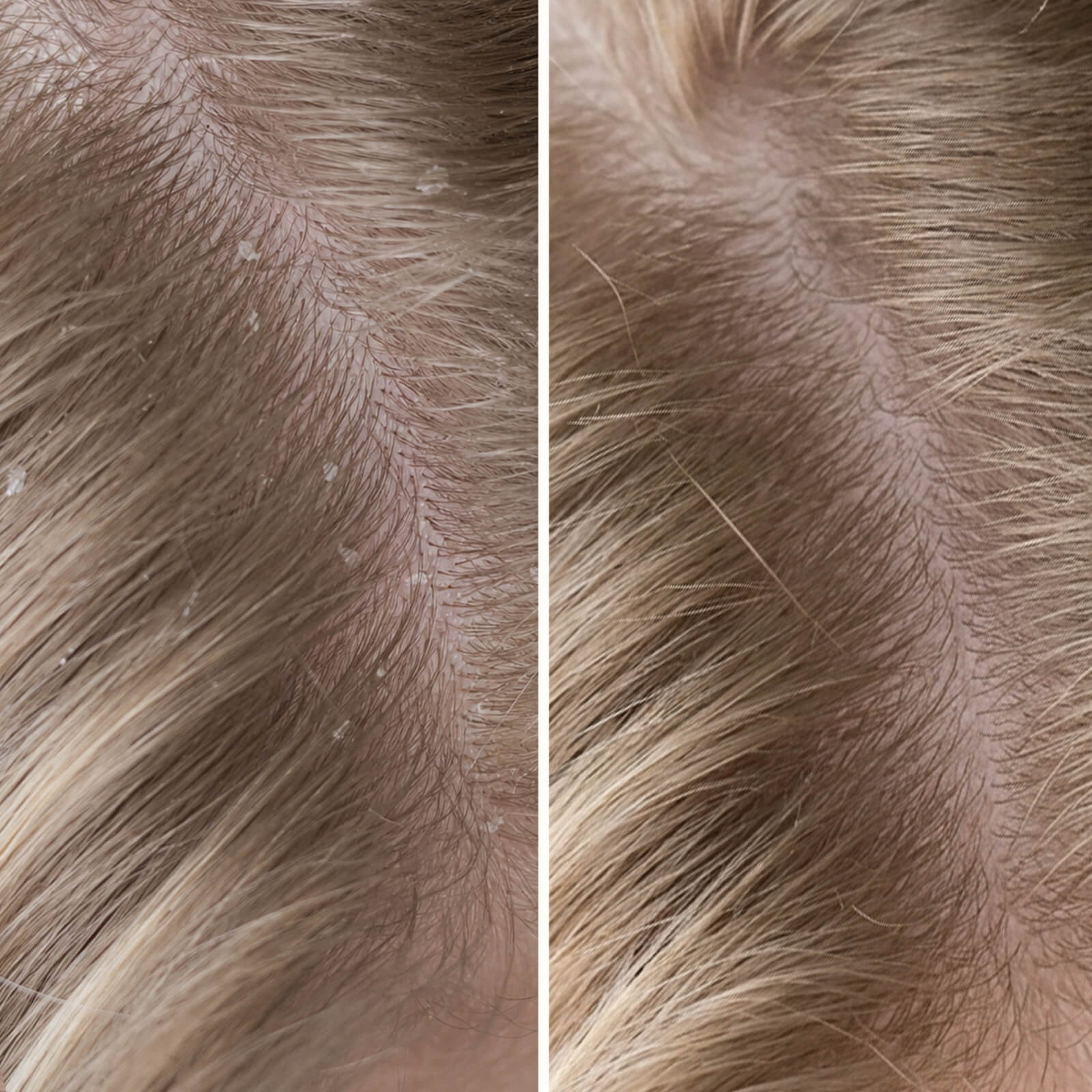 Salicylsyre Shampoo mod skæl, kløe og tør hovedbund — Shampoo mod skæl, kløe og tør hovedbund. Lindrer rødme og fjerner flager samt døde hudceller effektivt med eksfolierende salicylsyre.