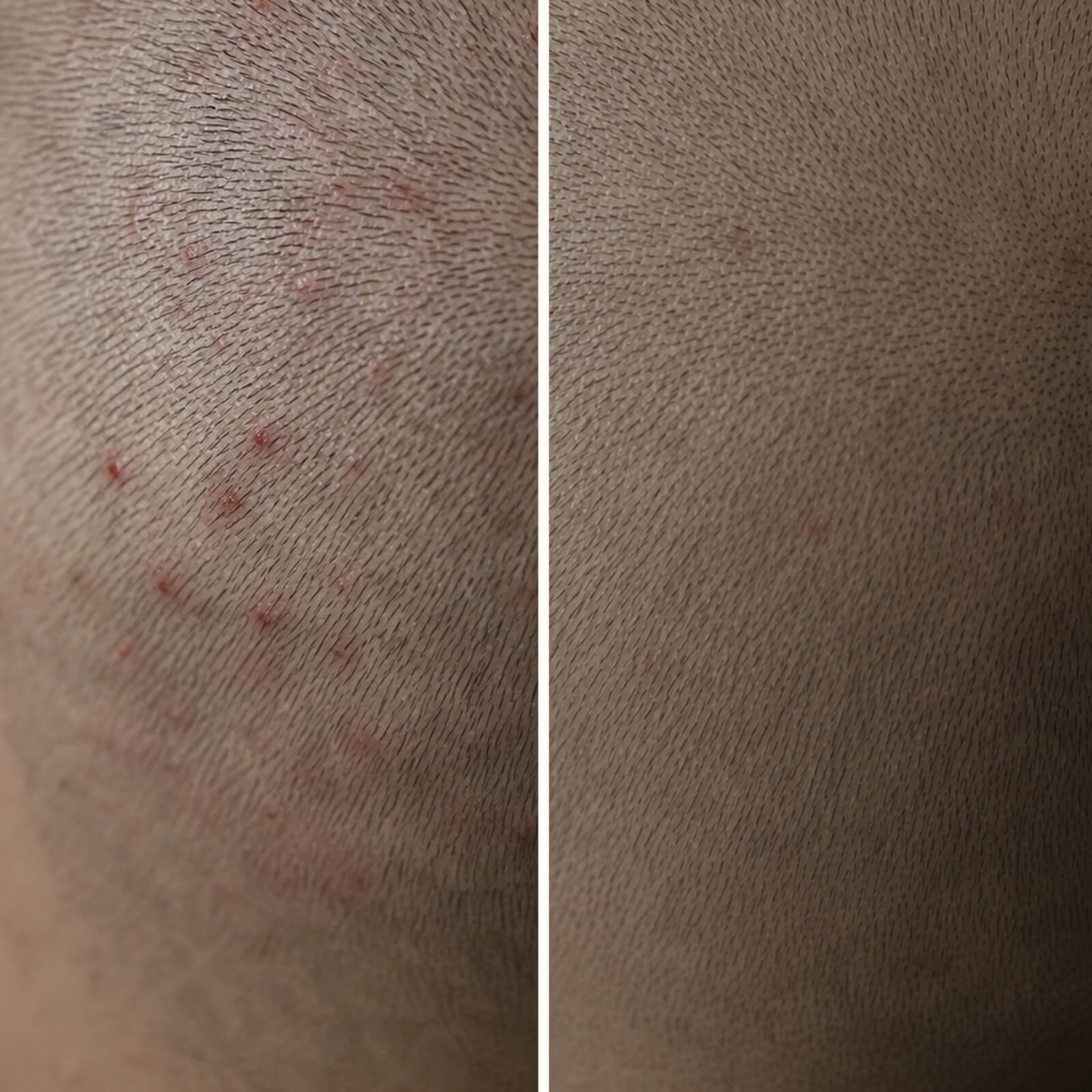 Salicylsyre Gel mod bumser og kløe i hovedbunden — Døjer du med bumser i hovedbunden? Gelen eksfolierer porerne, mindsker olie og beroliger rødme og kløe effektivt.