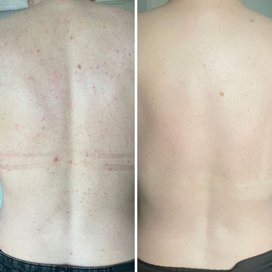Før- og efterbillede af en ryg med synlige bumser og akne før brug og en ren, glat ryg uden urenheder efter 4 ugers konsekvent brug af Australian Bodycare Salicylsyre Body Spray.