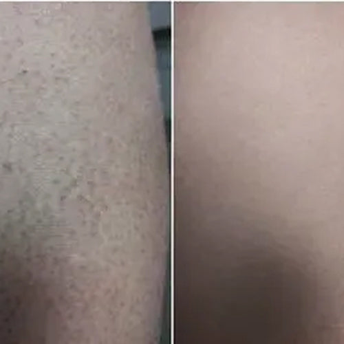 Alenas resultat efter 2 ugers brug af keratosis pilaris pakken – synligt glattere hud på overarme