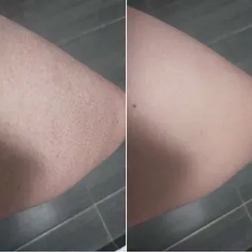Alenas keratosis pilaris før og efter – glattere hud efter 2 uger