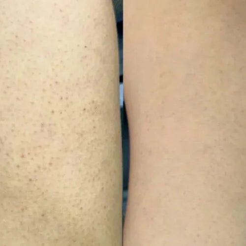 Isabells resultat efter brug af keratosis pilaris pakken – reduktion af knopper på lår