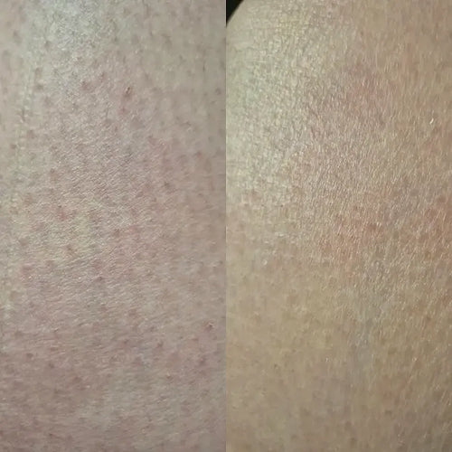 Nærbillede af hud efter keratosis pilaris behandling – Carolins resultat
