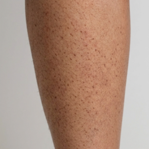 Nærbillede af keratosis pilaris – ru knopper på overarme