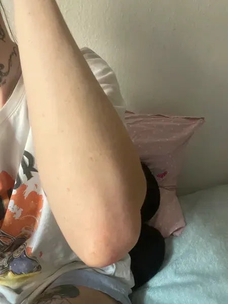 Keratosis pilaris kunderesultat – Lisa A. fra Frankrig