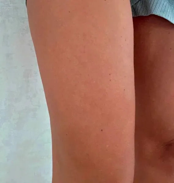 Keratosis pilaris kunderesultat – Sarah S. fra Sverige