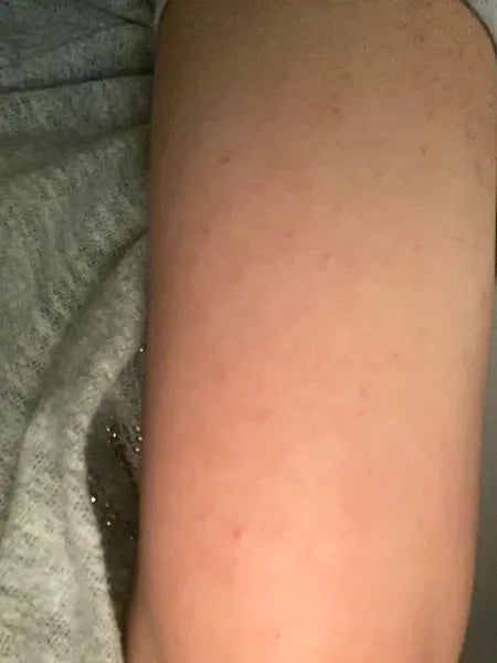 Keratosis pilaris kunderesultat – Shaian H. bruger Australian Bodycare