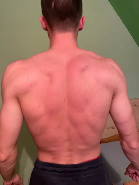 Kunderesultat bumser på kroppen – Marek D.