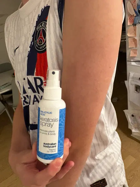 Keratosis pilaris resultat – 70% reduktion af knopper efter 3 uger